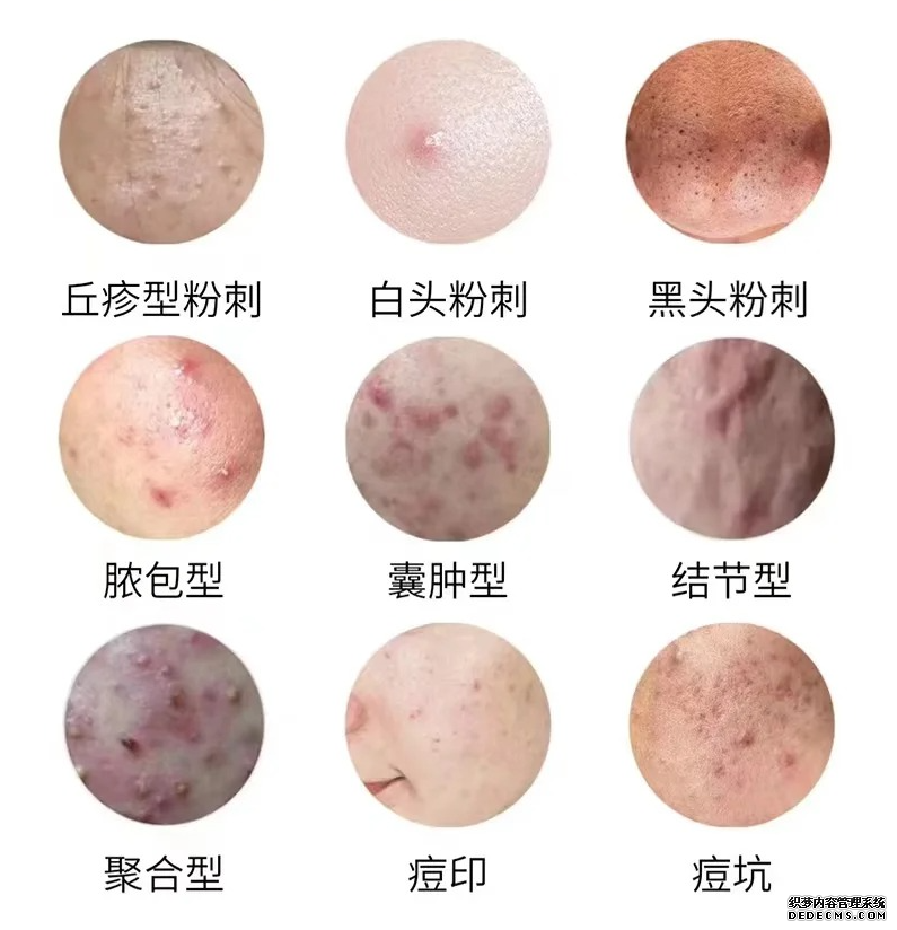 痘痘肌看过来_1_刘娜小助理_来自小红书网页版.jpg